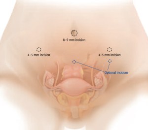 LSH_TLH_Incision_Areas_Larg